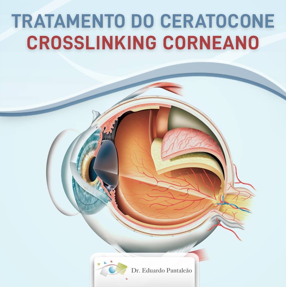 Tratamento Do Ceratocone Crosslinking Corneano Dr Eduardo Pantale O